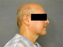 Liposuction After Photo by Ellen Janetzke, MD; Bloomfield Hills, MI - Case 27261