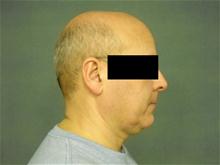 Liposuction Before Photo by Ellen Janetzke, MD; Bloomfield Hills, MI - Case 27261