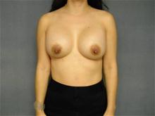 Breast Augmentation After Photo by Ellen Janetzke, MD; Bloomfield Hills, MI - Case 27459
