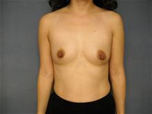 Breast Augmentation Before Photo by Ellen Janetzke, MD; Bloomfield Hills, MI - Case 27459
