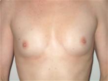 Breast Augmentation Before Photo by Ellen Janetzke, MD; Bloomfield Hills, MI - Case 27460