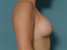 Breast Augmentation After Photo by Ellen Janetzke, MD; Bloomfield Hills, MI - Case 27460