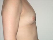 Breast Augmentation Before Photo by Ellen Janetzke, MD; Bloomfield Hills, MI - Case 27460