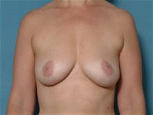Breast Augmentation Before Photo by Ellen Janetzke, MD; Bloomfield Hills, MI - Case 27461