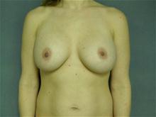 Breast Augmentation After Photo by Ellen Janetzke, MD; Bloomfield Hills, MI - Case 27462