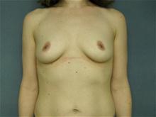 Breast Augmentation Before Photo by Ellen Janetzke, MD; Bloomfield Hills, MI - Case 27462