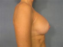 Breast Augmentation After Photo by Ellen Janetzke, MD; Bloomfield Hills, MI - Case 27463