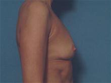 Breast Augmentation Before Photo by Ellen Janetzke, MD; Bloomfield Hills, MI - Case 27463