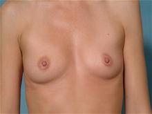 Breast Augmentation Before Photo by Ellen Janetzke, MD; Bloomfield Hills, MI - Case 27464