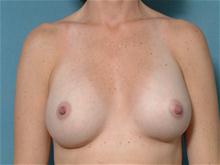 Breast Augmentation After Photo by Ellen Janetzke, MD; Bloomfield Hills, MI - Case 27465