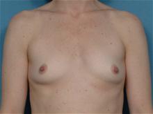 Breast Augmentation Before Photo by Ellen Janetzke, MD; Bloomfield Hills, MI - Case 27465