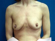 Breast Augmentation Before Photo by Ellen Janetzke, MD; Bloomfield Hills, MI - Case 27466