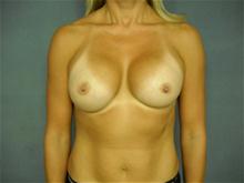 Breast Augmentation After Photo by Ellen Janetzke, MD; Bloomfield Hills, MI - Case 27467