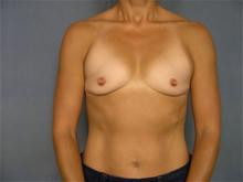 Breast Augmentation Before Photo by Ellen Janetzke, MD; Bloomfield Hills, MI - Case 27467