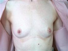 Breast Augmentation Before Photo by Ellen Janetzke, MD; Bloomfield Hills, MI - Case 27468