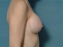 Breast Augmentation After Photo by Ellen Janetzke, MD; Bloomfield Hills, MI - Case 27468