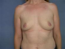 Breast Augmentation Before Photo by Ellen Janetzke, MD; Bloomfield Hills, MI - Case 27489