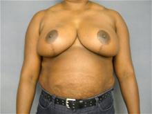 Breast Reduction After Photo by Ellen Janetzke, MD; Bloomfield Hills, MI - Case 27507