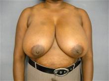 Breast Reduction Before Photo by Ellen Janetzke, MD; Bloomfield Hills, MI - Case 27507