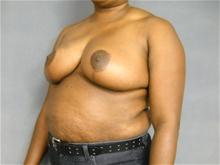 Breast Reduction After Photo by Ellen Janetzke, MD; Bloomfield Hills, MI - Case 27507