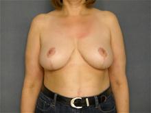 Breast Reduction After Photo by Ellen Janetzke, MD; Bloomfield Hills, MI - Case 27508