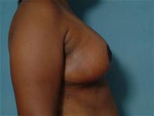 Breast Reduction After Photo by Ellen Janetzke, MD; Bloomfield Hills, MI - Case 27509