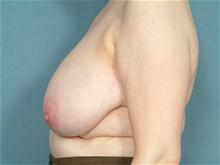 Breast Reduction Before Photo by Ellen Janetzke, MD; Bloomfield Hills, MI - Case 27510