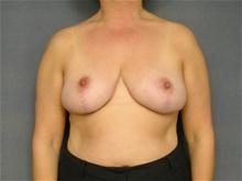 Breast Reduction After Photo by Ellen Janetzke, MD; Bloomfield Hills, MI - Case 27511