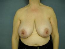 Breast Reduction Before Photo by Ellen Janetzke, MD; Bloomfield Hills, MI - Case 27511