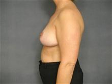 Breast Reduction After Photo by Ellen Janetzke, MD; Bloomfield Hills, MI - Case 27511
