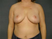 Breast Reduction After Photo by Ellen Janetzke, MD; Bloomfield Hills, MI - Case 27512