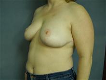 Breast Reduction After Photo by Ellen Janetzke, MD; Bloomfield Hills, MI - Case 27512