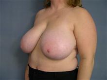 Breast Reduction Before Photo by Ellen Janetzke, MD; Bloomfield Hills, MI - Case 27512