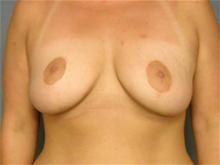 Breast Reduction After Photo by Ellen Janetzke, MD; Bloomfield Hills, MI - Case 27513