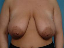 Breast Reduction Before Photo by Ellen Janetzke, MD; Bloomfield Hills, MI - Case 27513
