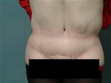 Tummy Tuck After Photo by Ellen Janetzke, MD; Bloomfield Hills, MI - Case 27514