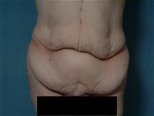 Tummy Tuck Before Photo by Ellen Janetzke, MD; Bloomfield Hills, MI - Case 27514