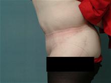 Tummy Tuck After Photo by Ellen Janetzke, MD; Bloomfield Hills, MI - Case 27514