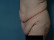 Tummy Tuck Before Photo by Ellen Janetzke, MD; Bloomfield Hills, MI - Case 27514