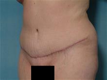 Tummy Tuck After Photo by Ellen Janetzke, MD; Bloomfield Hills, MI - Case 27515