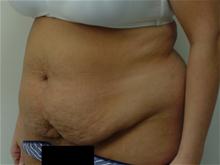 Tummy Tuck Before Photo by Ellen Janetzke, MD; Bloomfield Hills, MI - Case 27515