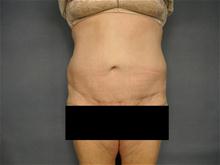 Tummy Tuck After Photo by Ellen Janetzke, MD; Bloomfield Hills, MI - Case 27516