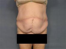 Tummy Tuck Before Photo by Ellen Janetzke, MD; Bloomfield Hills, MI - Case 27516