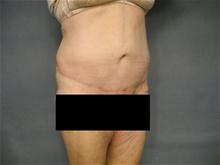 Tummy Tuck After Photo by Ellen Janetzke, MD; Bloomfield Hills, MI - Case 27516