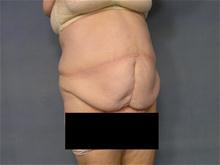 Tummy Tuck Before Photo by Ellen Janetzke, MD; Bloomfield Hills, MI - Case 27516