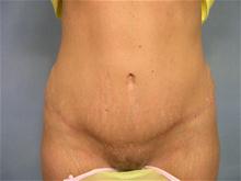 Tummy Tuck After Photo by Ellen Janetzke, MD; Bloomfield Hills, MI - Case 27517