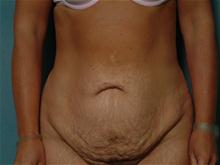 Tummy Tuck Before Photo by Ellen Janetzke, MD; Bloomfield Hills, MI - Case 27517