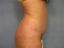 Tummy Tuck After Photo by Ellen Janetzke, MD; Bloomfield Hills, MI - Case 27517