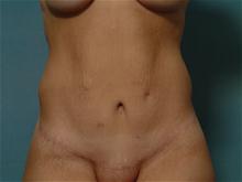 Tummy Tuck After Photo by Ellen Janetzke, MD; Bloomfield Hills, MI - Case 27518