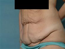 Tummy Tuck Before Photo by Ellen Janetzke, MD; Bloomfield Hills, MI - Case 27518